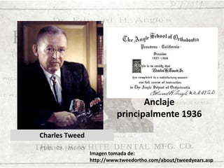 Anclaje
principalmente 1936
Charles Tweed
Imagen tomada de:
7
http://www.tweedortho.com/about/tweedyears.asp

 
