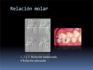 Relación molar
1, 2 y 3. Relación inadecuada.
4 Relación adecuada
 