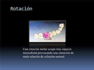 Rotación
Una rotación molar ocupa mas espacio
mesiodistal provocando una situación de
mala relación de oclusión normal
 