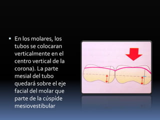  En los molares, los
tubos se colocaran
verticalmente en el
centro vertical de la
corona). La parte
mesial del tubo
quedará sobre el eje
facial del molar que
parte de la cúspíde
mesiovestibular
 