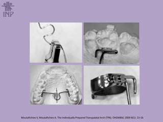 Moutaftchiev V, Moutaftchiev A. The Individually Prepared Transpalatal Arch (TPA). OHDMBSC 2009 8(1): 13-16
 