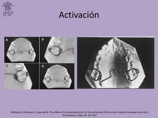 Activación
Dahlquist A, Gebauer U, Ingervall B. The effect of a transpalatal arch for the correction of first molar rotation European Journal of
Orthodontics 1996; 18: 257-267
 