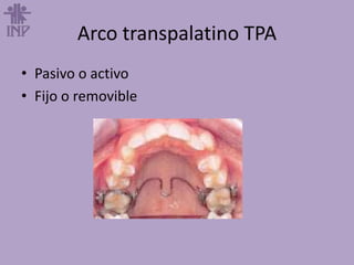 Arco transpalatino TPA
• Pasivo o activo
• Fijo o removible
 