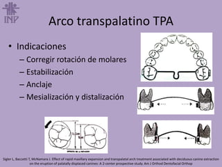 Arco transpalatino TPA
• Indicaciones
– Corregir rotación de molares
– Estabilización
– Anclaje
– Mesialización y distalización
Sigler L, Baccetti T, McNamara J. Effect of rapid maxillary expansion and transpalatal arch treatment associated with deciduous canine extraction
on the eruption of palatally displaced canines: A 2-center prospective study. Am J Orthod Dentofacial Orthop
 