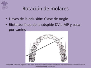 Rotación de molares
• Llaves de la oclusión: Clase de Angle
• Ricketts: línea de la cúspide DV a MP y pasa
por canino
Dahlquist A, Gebauer U, Ingervall B. The effect of a transpalatal arch for the correction of first molar rotation European Journal of
Orthodontics 1996; 18: 257-267
 
