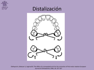 Distalización
Dahlquist A, Gebauer U, Ingervall B. The effect of a transpalatal arch for the correction of first molar rotation European
Journal of Orthodontics 1996; 18: 257-267
 