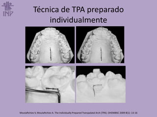 Técnica de TPA preparado
individualmente
Moutaftchiev V, Moutaftchiev A. The Individually Prepared Transpalatal Arch (TPA). OHDMBSC 2009 8(1): 13-16
 