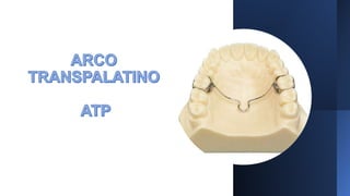 Arco Transpalatino Y Arco Lingual PPTX arco-transpalatino-y-arco-lingual-pptx