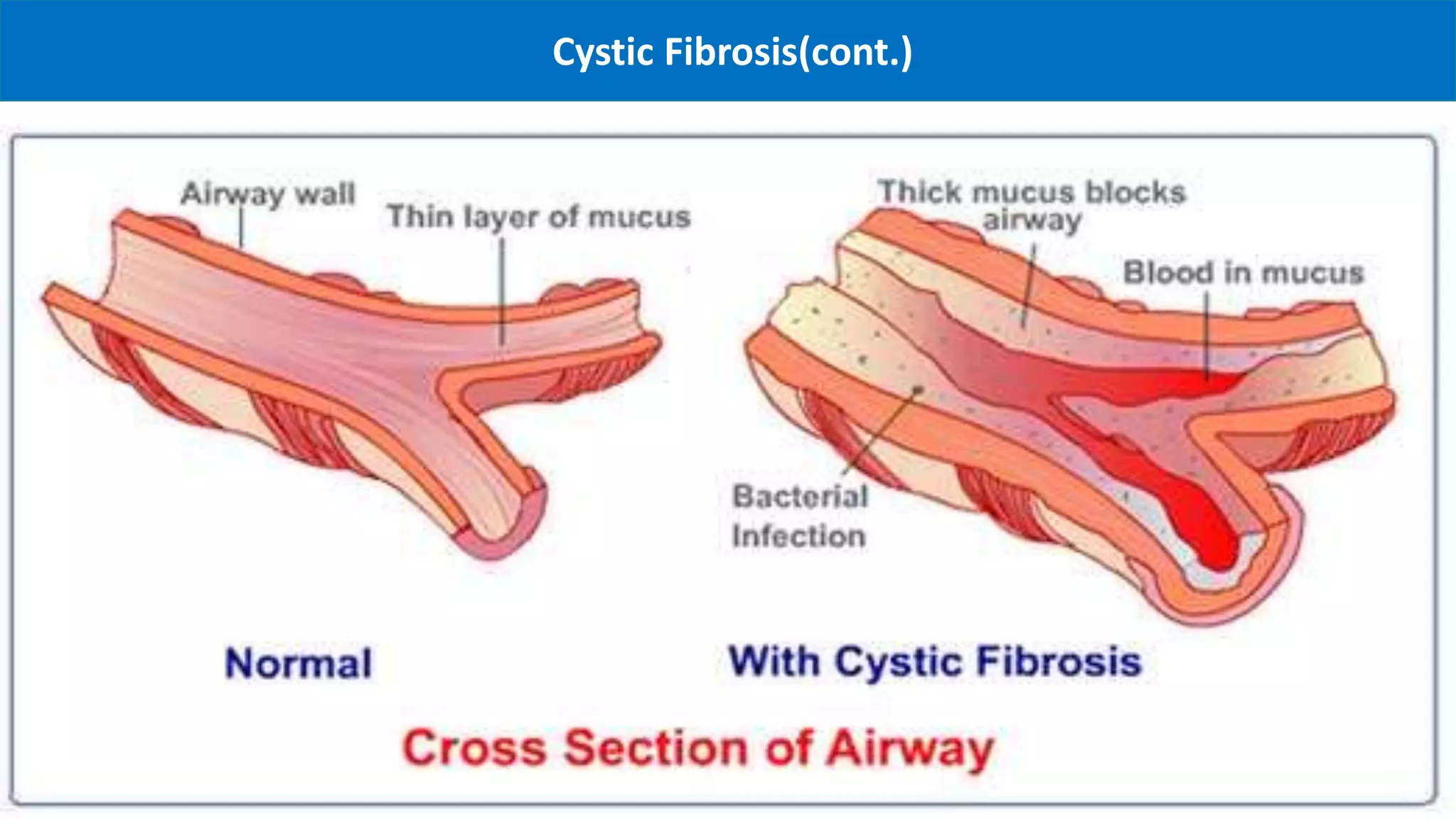 Autosomal recessive diseases | PPTX