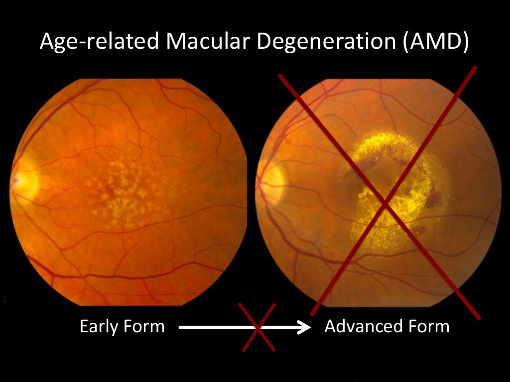 Agerelated Macular Degeneration (AMD) Early