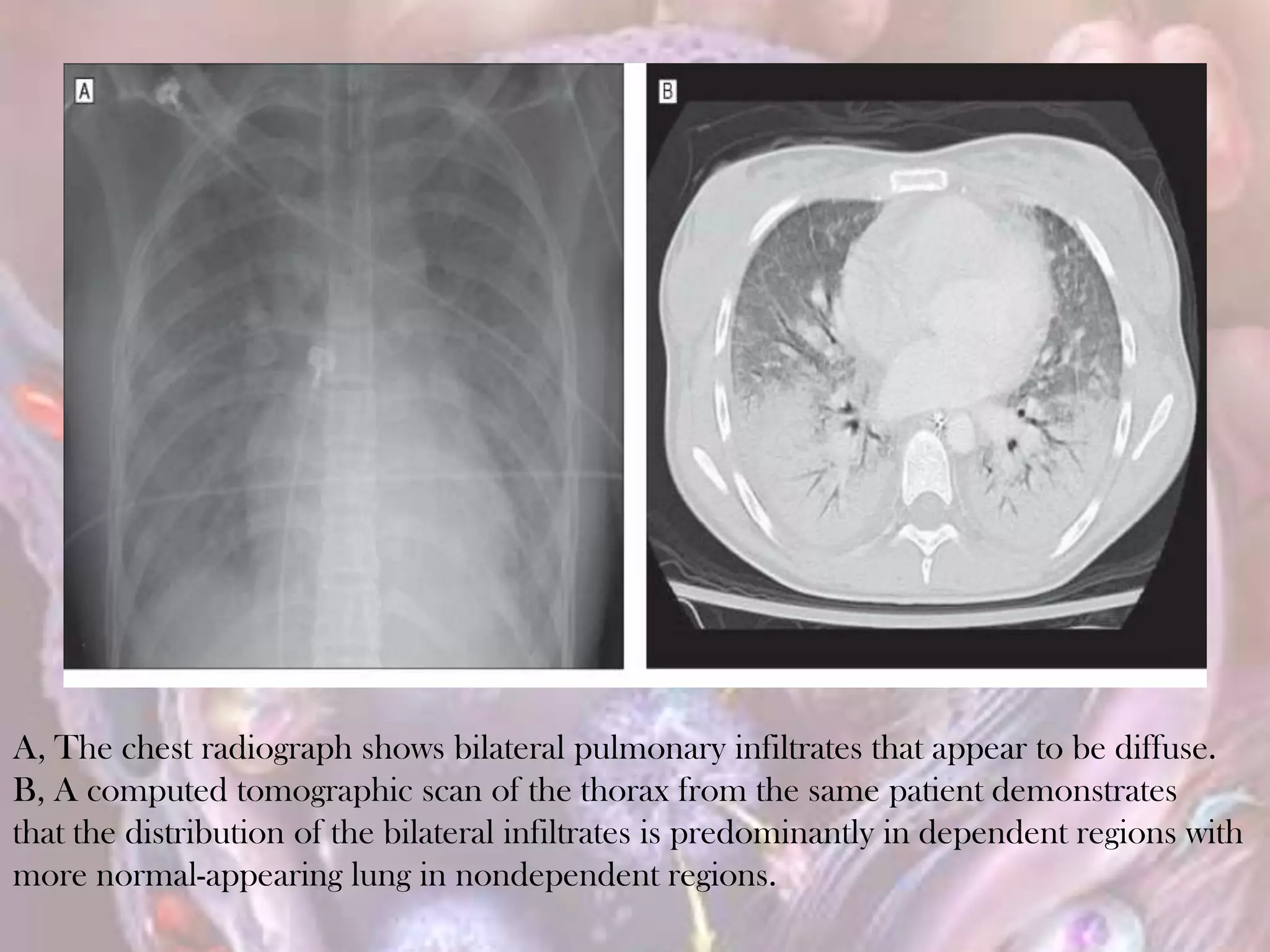 A, The chest radiograph shows bilateral pulmonary infiltrates that appear to be diffuse.
B, A computed tomographic scan of the thorax from the same patient demonstrates
that the distribution of the bilateral infiltrates is predominantly in dependent regions with
more normal-appearing lung in nondependent regions.
 