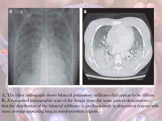 A, The chest radiograph shows bilateral pulmonary infiltrates that appear to be diffuse.
B, A computed tomographic scan of the thorax from the same patient demonstrates
that the distribution of the bilateral infiltrates is predominantly in dependent regions with
more normal-appearing lung in nondependent regions.
 