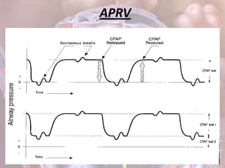 APRV
 