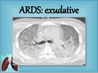 ARDS: exudative
 