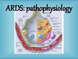 ARDS: pathophysiology
 