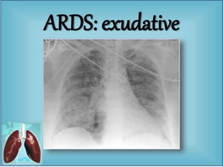 ARDS: exudative
 