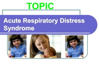 Acute Respiratory Distress
Syndrome
TOPIC
 
