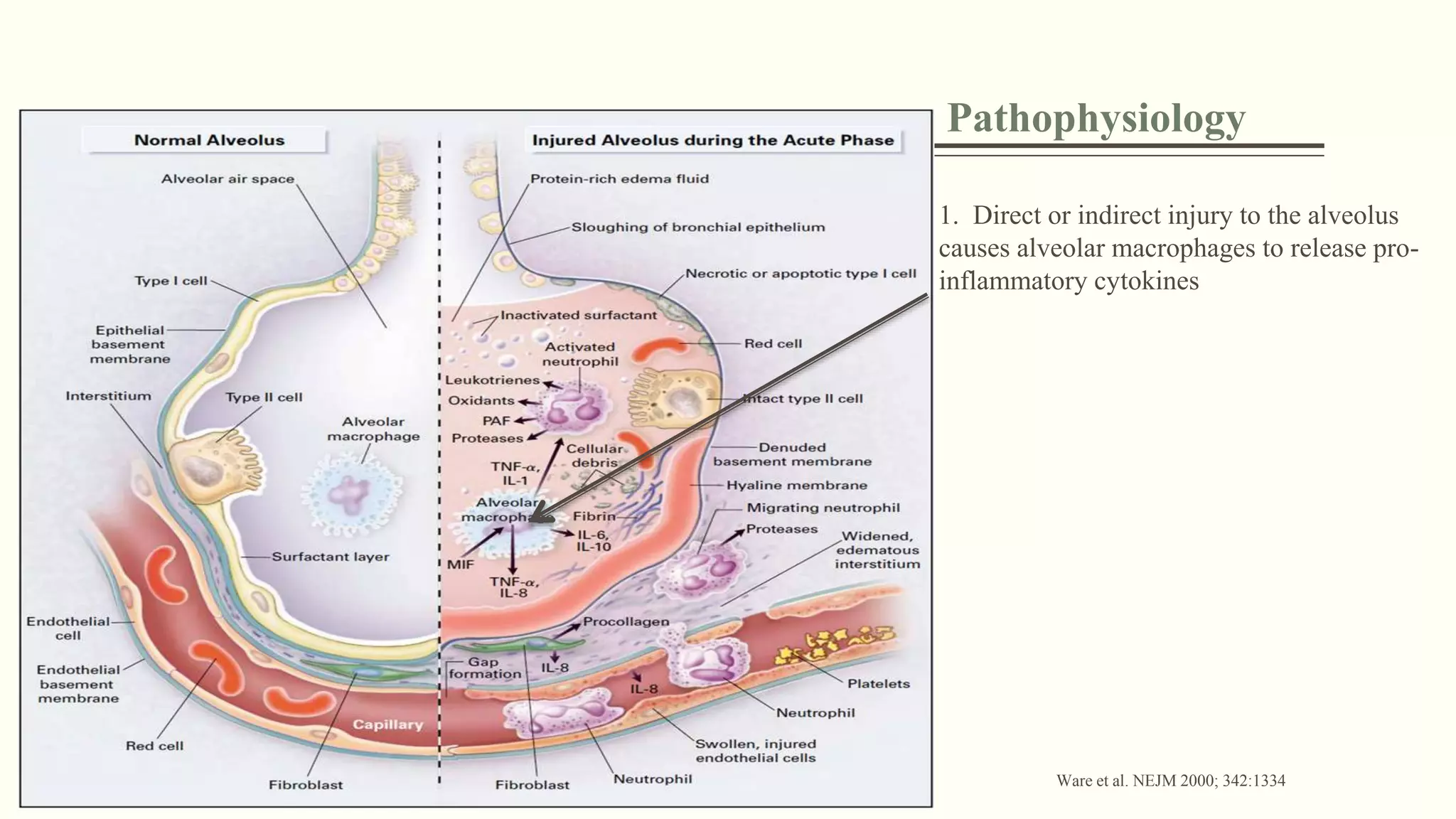 Pathophysiology
1. Direct or indirect injury to the alveolus
causes alveolar macrophages to release pro-
inflammatory cytokines
Ware et al. NEJM 2000; 342:1334
 