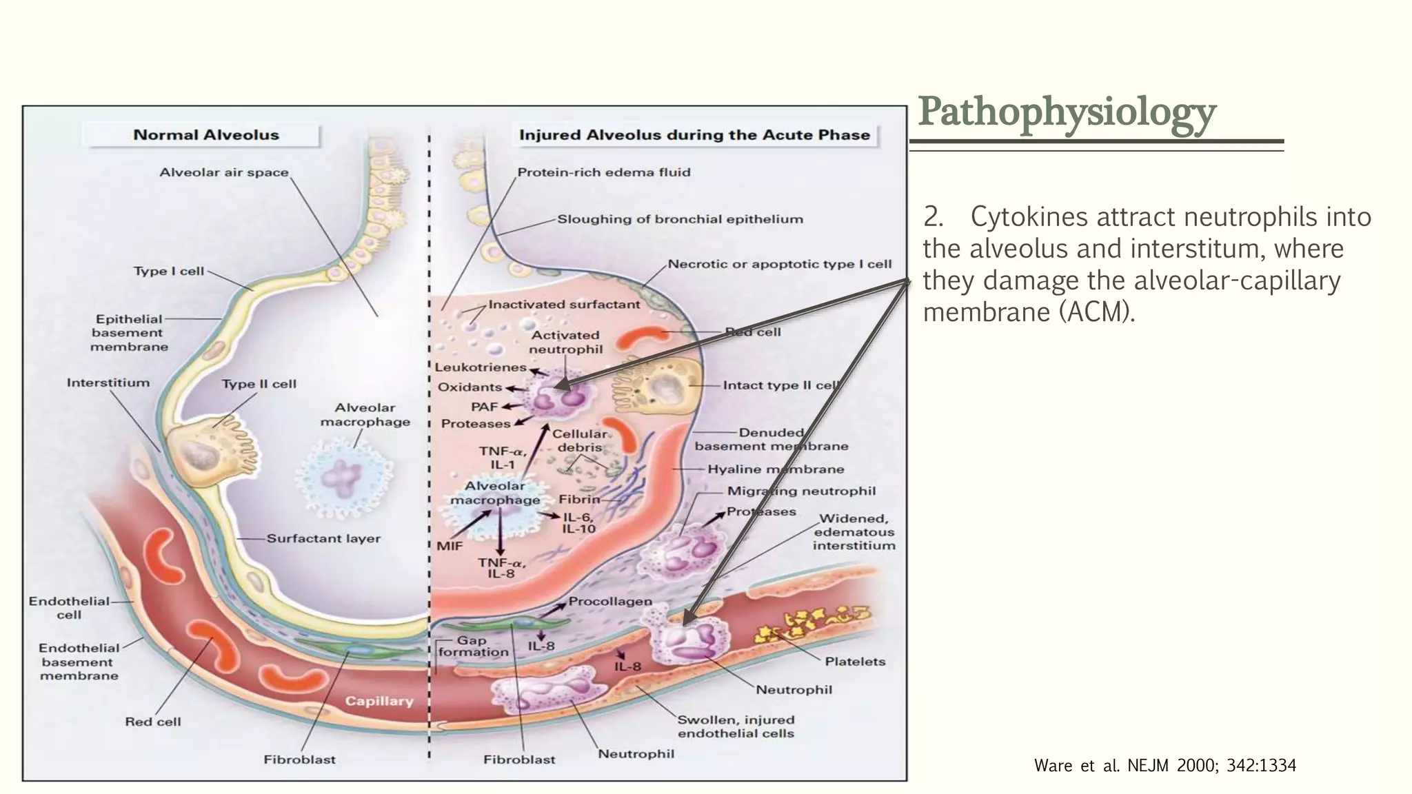 Pathophysiology
2. Cytokines attract neutrophils into
the alveolus and interstitum, where
they damage the alveolar-capillary
membrane (ACM).
Ware et al. NEJM 2000; 342:1334
 