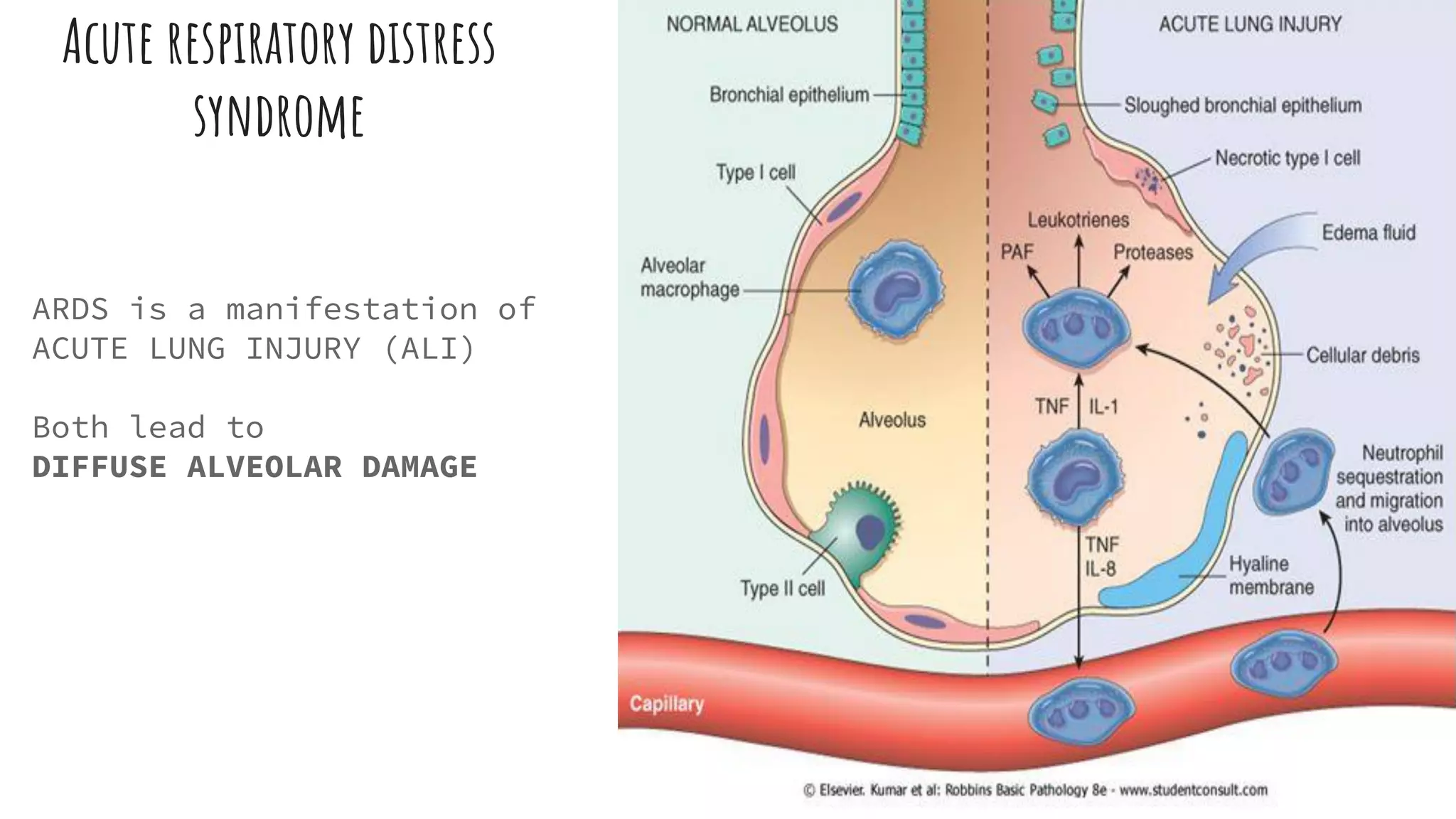 ARDS ( Acute Respiratory Distress Syndrome ) | PDF