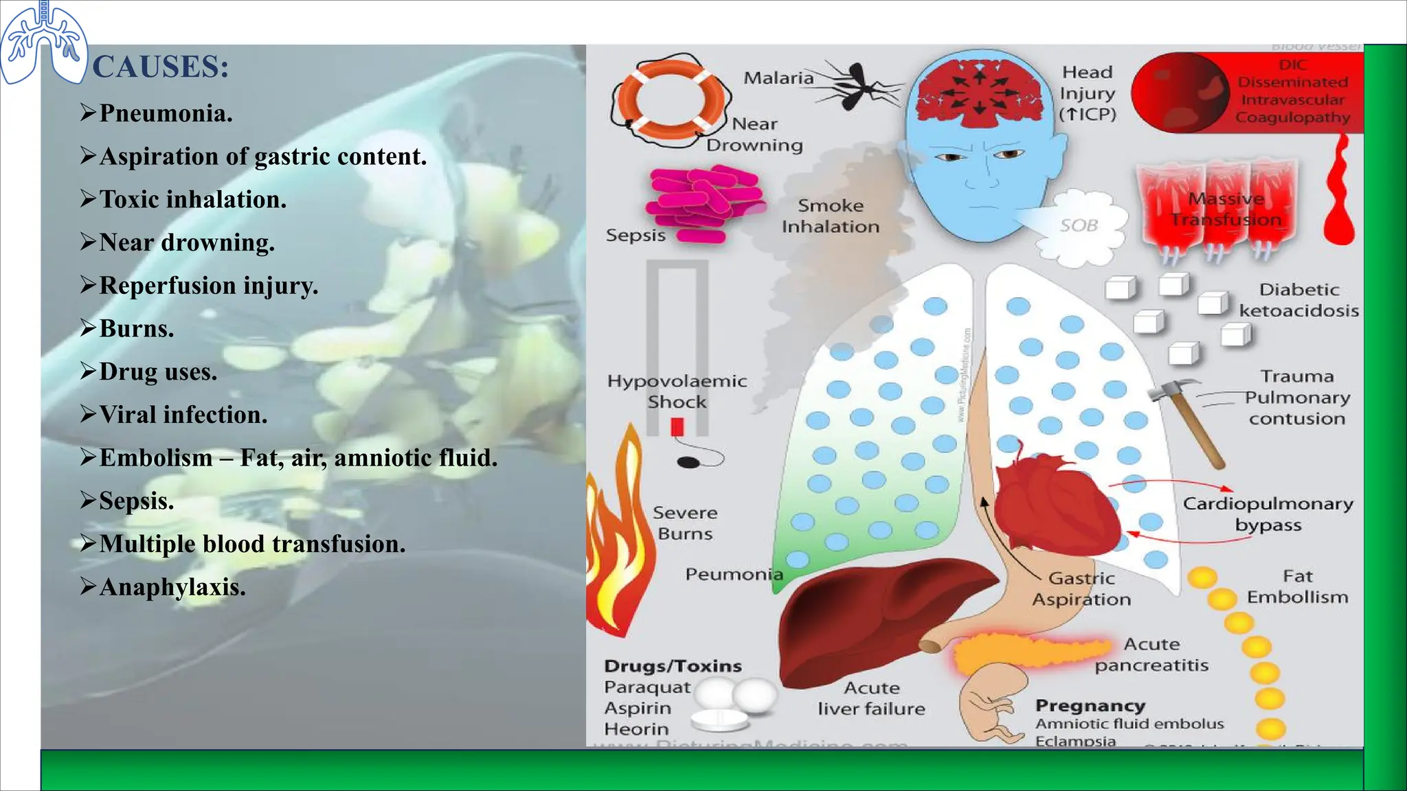 CAUSES:
ØPneumonia.
ØAspiration of gastric content.
ØToxic inhalation.
ØNear drowning.
ØReperfusion injury.
ØBurns.
ØDrug uses.
ØViral infection.
ØEmbolism – Fat, air, amniotic fluid.
ØSepsis.
ØMultiple blood transfusion.
ØAnaphylaxis.
 
