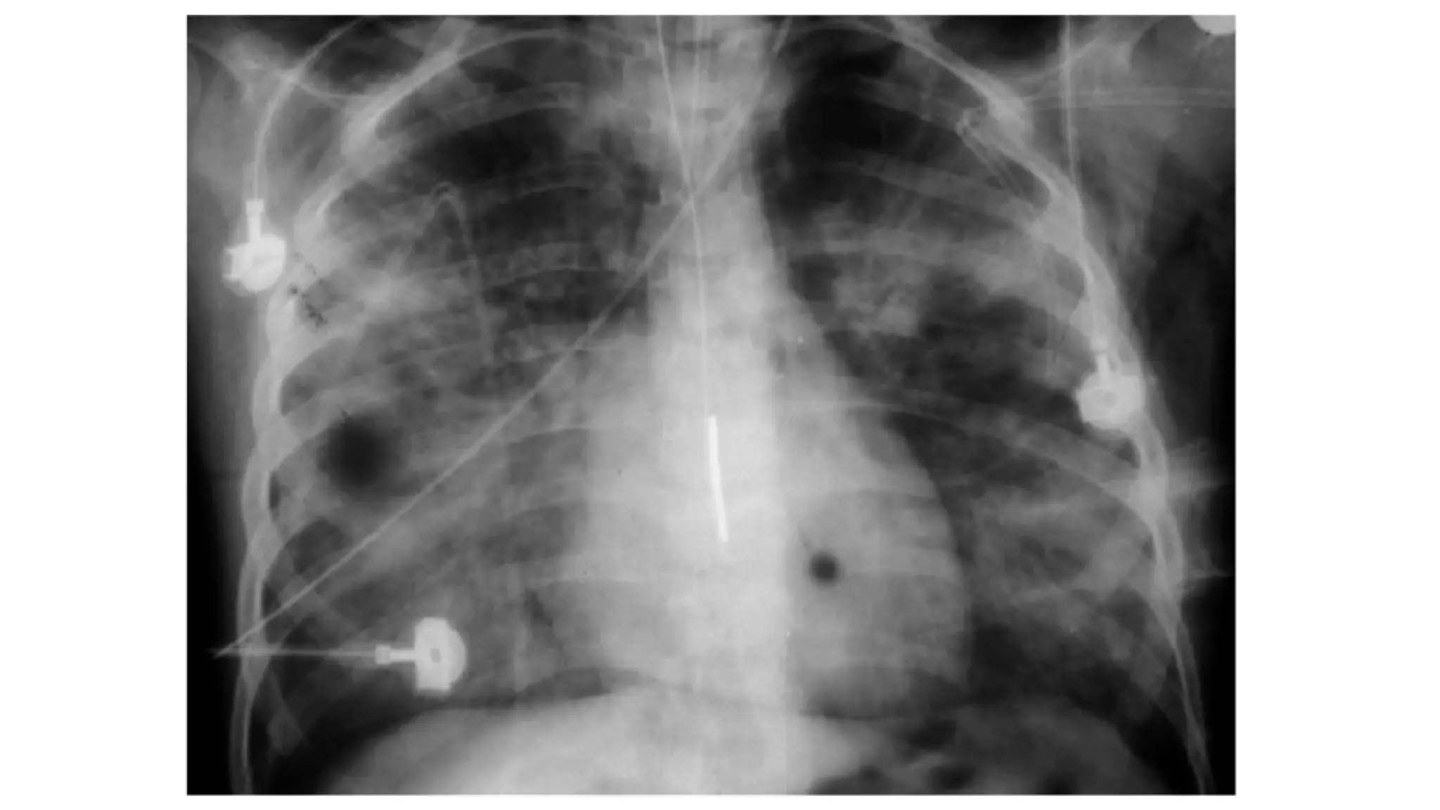 S ndrome De Distr s Respiratorio Agudo SDRA PPTX s-ndrome-de-distr-s-respiratorio-agudo-sdra-pptx