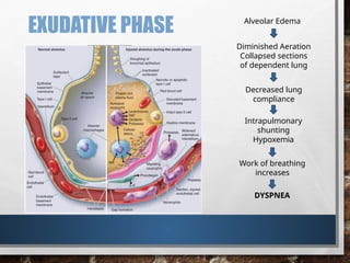 Acute Respiratory Distress Syndrome A powerpoint presentation | PPTX