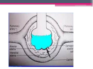 ARDS Acute Respiratory Distress Syndrome (ARDS) PPTX | PPTX