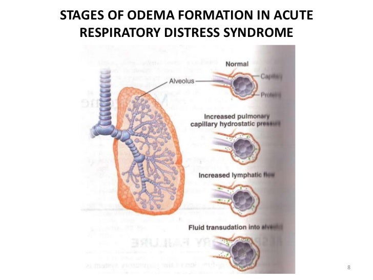 Ards Pathophysiology Flow Chart