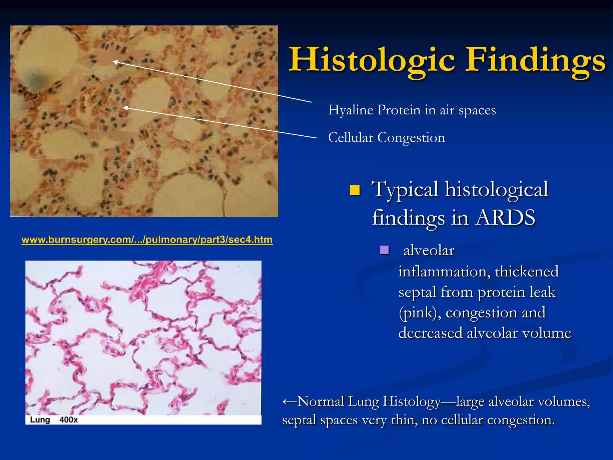 Histologic Findings
                                                          Hyaline Protein in air spaces
                                                          Cellular Congestion


                                                                Typical histological
                                                                 findings in ARDS
www.burnsurgery.com/.../pulmonary/part3/sec4.htm
                                                                   alveolar
                                                                      inflammation, thickened
                                                                      septal from protein leak
                                                                      (pink), congestion and
                                                                      decreased alveolar volume


                                                   ←Normal Lung Histology—large alveolar volumes,
                                                   septal spaces very thin, no cellular congestion.
 
