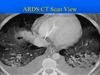 ARDS:CT Scan View 