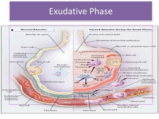 Exudative Phase
•
 