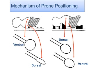Dorsal
VentralDorsal
Ventral
Mechanism of Prone Positioning
 