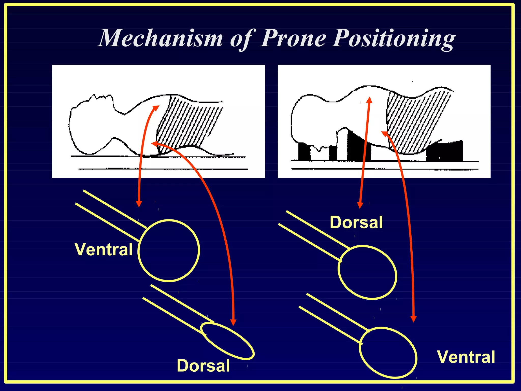 Ventral
Dorsal
Dorsal
Ventral
Mechanism of Prone Positioning
 