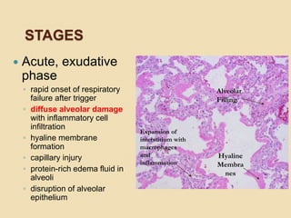 ARDS Berlin DEFINITION.pptx