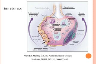 ARDS | PDF