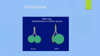 Volutrauma
 