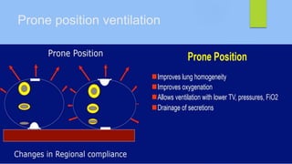 Prone position ventilation
 