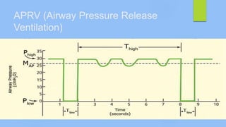 APRV (Airway Pressure Release
Ventilation)
 