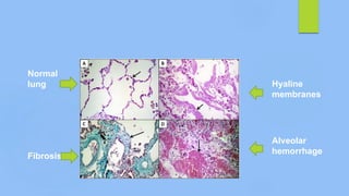 Normal
lung Hyaline
membranes
Fibrosis
Alveolar
hemorrhage
 