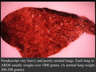 Nondescript very heavy and poorly aerated lungs. Each lung in  ARDS usually weighs over 1000 grams. (A normal lung weighs 200-300 grams)  