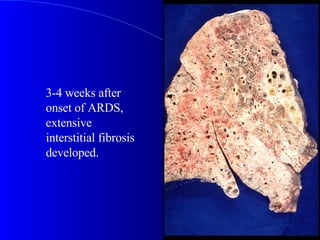 3-4 weeks after onset of ARDS, extensive interstitial fibrosis developed.  