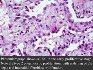 Photomicrograph shows ARDS in the early proliferative stage. Note the type 2 pneumocytic proliferation, with widening of the septa and interstitial fibroblast proliferation.  