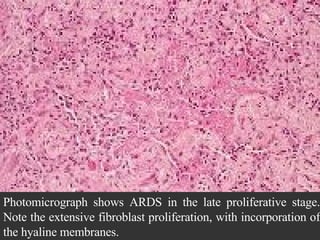 Photomicrograph shows ARDS in the late proliferative stage. Note the extensive fibroblast proliferation, with incorporation of the hyaline membranes.  