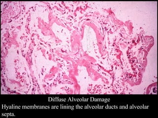Diffuse Alveolar Damage Hyaline membranes are lining the alveolar ducts and alveolar septa.  
