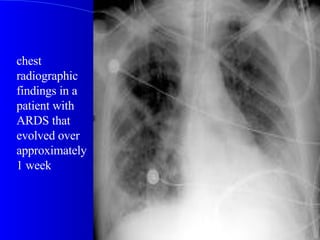 chest radiographic findings in a patient with ARDS that evolved over approximately 1 week  