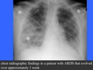 chest radiographic findings in a patient with ARDS that evolved over approximately 1 week  
