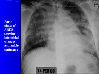 Early phase of ARDS showing interstitial changes and patchy infiltrates   