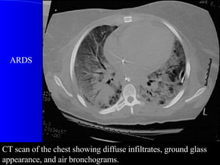 CT scan of the chest showing diffuse infiltrates, ground glass appearance, and air bronchograms.  ARDS 