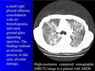 a small right pleural effusion, consolidation with air-bronchograms, and some ground-glass appearing opacities. The findings indicate an alveolar process, in this case, alveolar damage.  High-resolution computed tomographic (HRCT) image in a patient with ARDS 